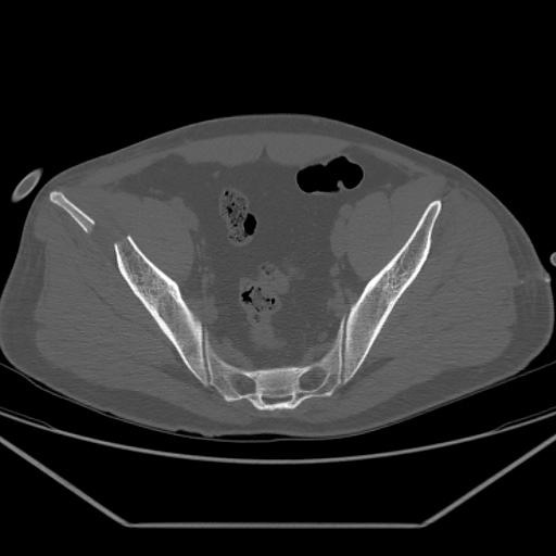 Acetabular and ilial fractures (Radiopaedia 59084-66378 Axial bone window 29).jpg