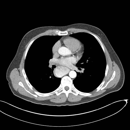 File:Achalasia of the cardia (Radiopaedia 38497-40595 Coronal C+ arterial phase 1).png