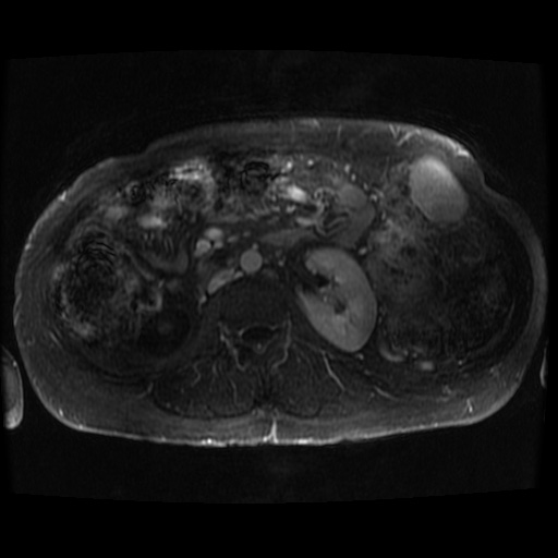Acinar cell carcinoma of the pancreas (Radiopaedia 75442-86668 Axial T1 C+ fat sat 19).jpg