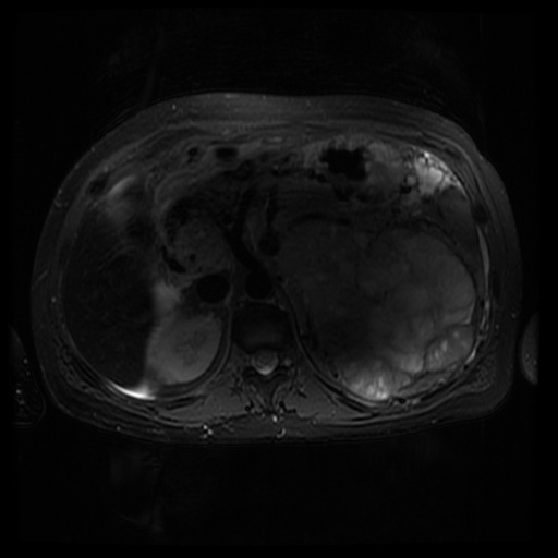 Acinar cell carcinoma of the pancreas (Radiopaedia 75442-86668 Axial T2 fat sat 31).jpg