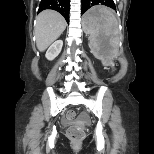 File:Acinar cell carcinoma of the pancreas (Radiopaedia 75442-86669 Coronal C+ portal venous phase 92).jpg