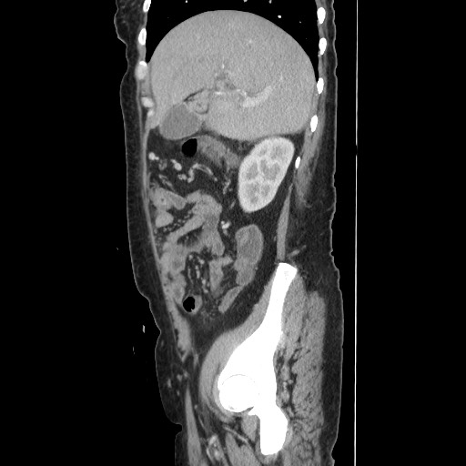Acinar cell carcinoma of the pancreas (Radiopaedia 75442-86669 Sagittal C+ portal venous phase 60).jpg
