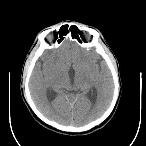 File:Acoustic schwannoma (Radiopaedia 29488-29982 AXIAL THICK non-contrast 23).jpg