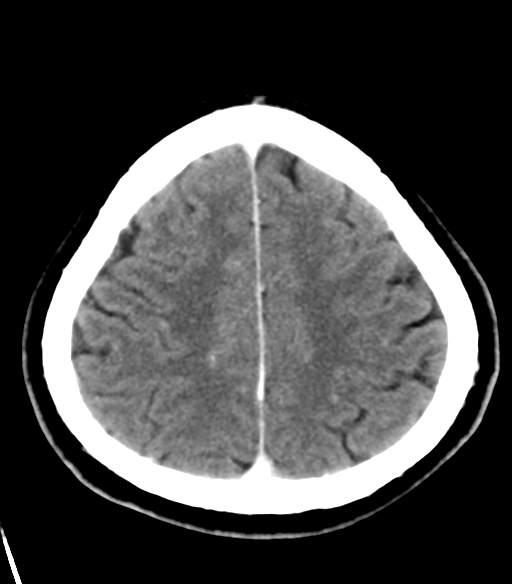 File:Acoustic schwannoma (Radiopaedia 33045-34065 Axial C+ delayed 22).png