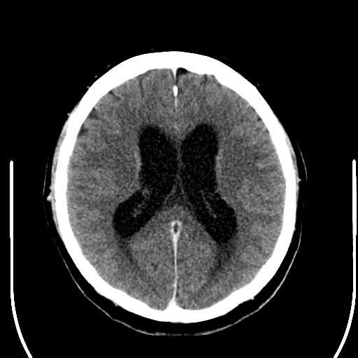 File:Acoustic schwannoma (Radiopaedia 39170-41389 Axial C+ 17).png