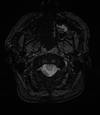 Acoustic schwannoma (Radiopaedia 50846-56358 Axial SWI 3).png