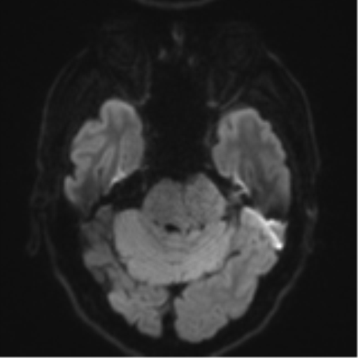 Acoustic schwannoma (Radiopaedia 55729-62281 E 34).png