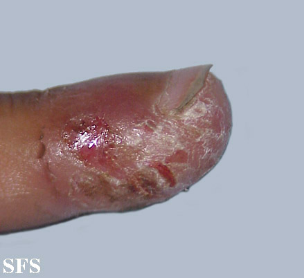 Acrodermatitis Continua (Dermatology Atlas 3).jpg