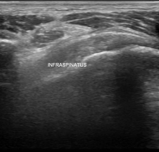 File:Acromial fracture - ultrasound (Radiopaedia 26729-26891 H 1).jpg