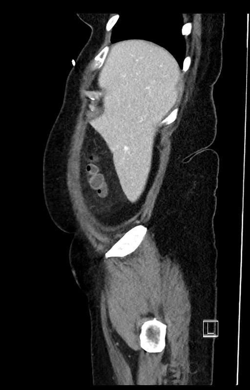 Active Crohn disease (Radiopaedia 59394-66750 Sagittal C+ portal venous phase 51).jpg