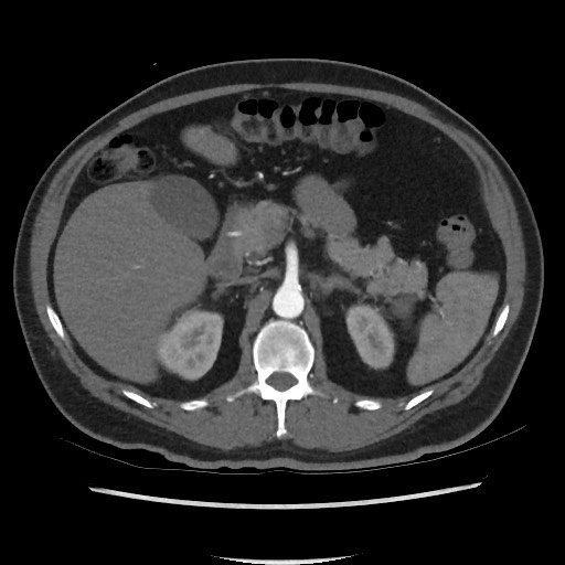 File:Active colonic bleed on CT (Radiopaedia 49765-55025 Axial C+ arterial phase 27).jpg