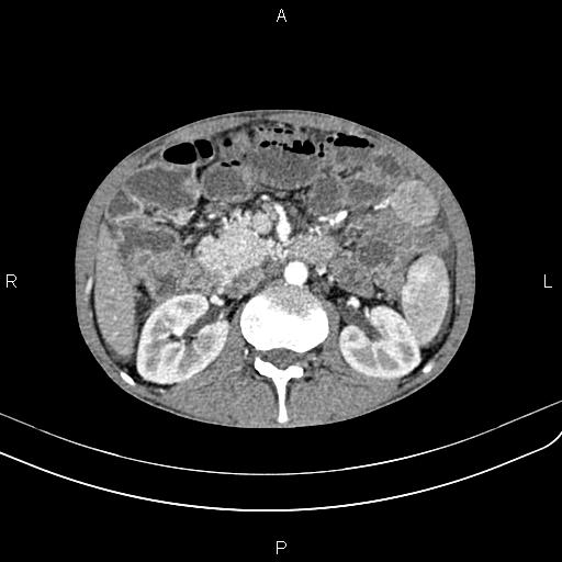 Active crohn disease (Radiopaedia 87133-103397 Axial C+ arterial phase 44).jpg