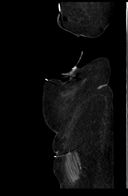 Active renal extravasation with large subcapsular and retroperitoneal hemorrhage (Radiopaedia 60975-68796 Sagittal C+ portal venous phase 28).jpg