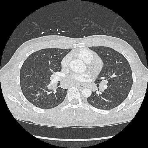 File:Active right ventricular cardiac sarcoidosis (Radiopaedia 55596-62101 Axial lung window 22).jpg