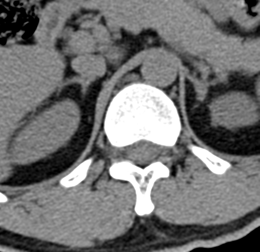 File:Acute L1 burst compression fracture (Radiopaedia 34430-35755 Axial non-contrast 4).png