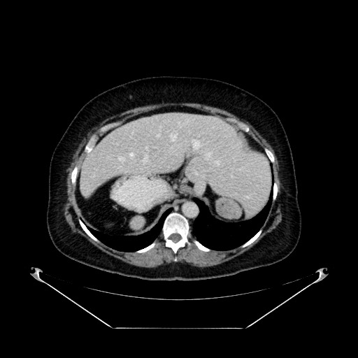 Acute appendicitis, heterotaxy syndrome (Radiopaedia 66884-76202 Axial C+ portal venous phase 28).jpg