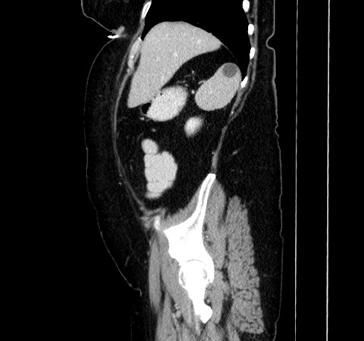 Acute appendicitis, heterotaxy syndrome (Radiopaedia 66884-76202 Sagittal C+ portal venous phase 36).jpg