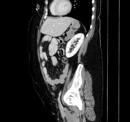 Acute appendicitis, heterotaxy syndrome (Radiopaedia 66884-76202 Sagittal C+ portal venous phase 93).jpg