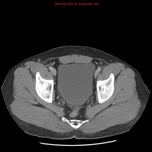 File:Acute appendicitis (Radiopaedia 10498-10973 Axial C+ portal venous phase 55).jpg