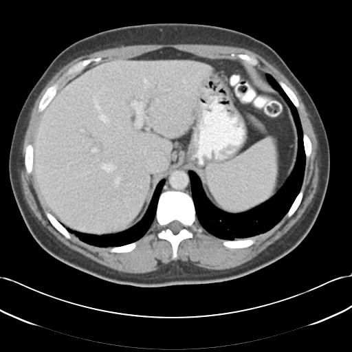 Acute appendicitis (Radiopaedia 30297-30934 Axial C+ portal venous phase 15).jpg