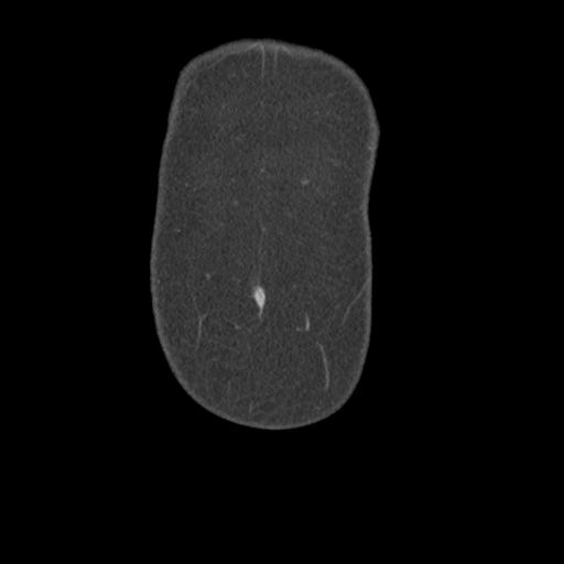 Acute appendicitis (Radiopaedia 30297-30934 Coronal C+ portal venous phase 2).jpg
