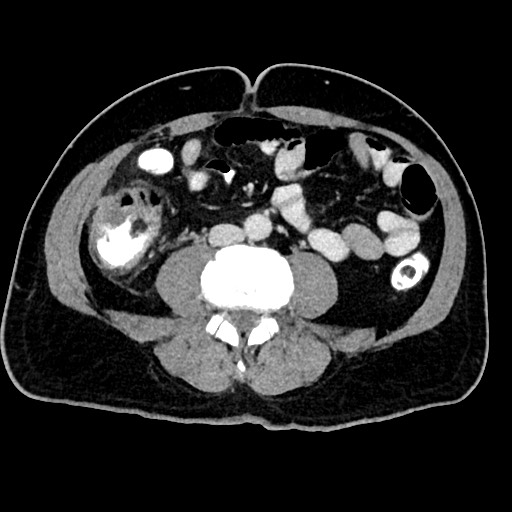 Acute appendicitis (Radiopaedia 77016-88960 Axial C+ portal venous phase 85).jpg