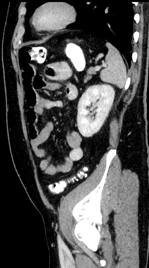 Acute appendicitis (Radiopaedia 77016-88960 Sagittal C+ portal venous phase 30).jpg