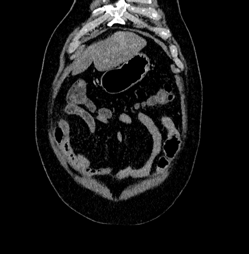 Acute appendicitis (Radiopaedia 79950-93224 Coronal C+ portal venous phase 11).jpg