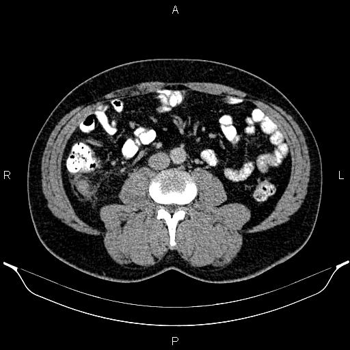 File:Acute appendicitis (Radiopaedia 84780-100240 Axial C+ portal venous phase 58).jpg