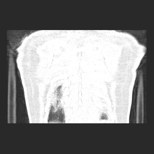 File:Acute appendicitis and COVID 19 pneumonia (Radiopaedia 76604-88380 G 59).jpg