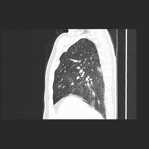 File:Acute appendicitis and COVID 19 pneumonia (Radiopaedia 76604-88380 Sagittal lung window 30).jpg