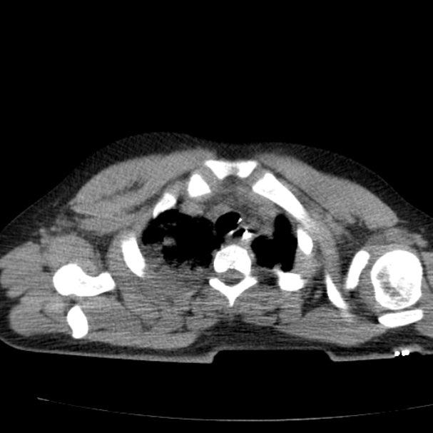 Acute aspiration pneumonitis (Radiopaedia 33605-34703 Axial non-contrast 23).jpg