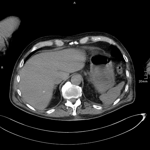 Acute aspiration pneumonitis (Radiopaedia 55642-62166 Axial liver window 56).jpg