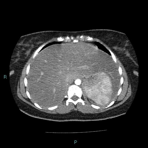Acute bilateral pyelonephritis (Radiopaedia 37146-38881 Axial C+ arterial phase 21).jpg