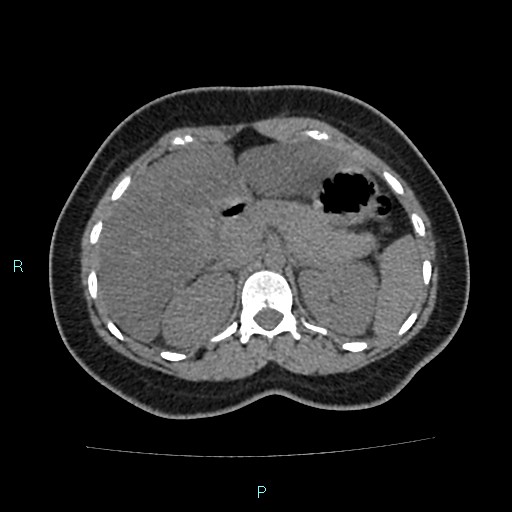 Acute bilateral pyelonephritis (Radiopaedia 37146-38881 Axial non-contrast 33).jpg