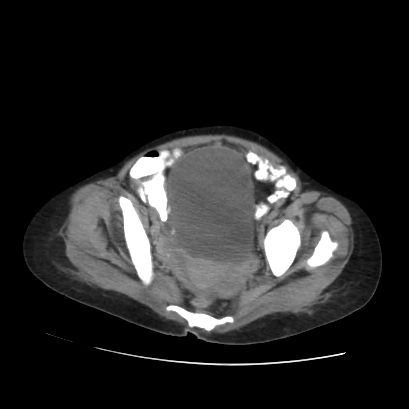 File:Acute calculous cholecystitis in patient with osteopetrosis (Radiopaedia 77871-90159 Axial non-contrast 69).jpg