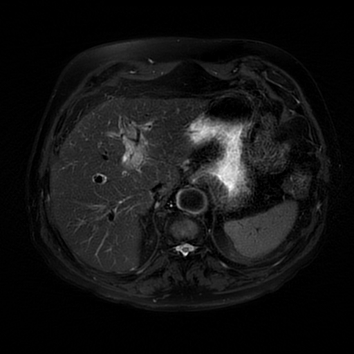 File:Acute cholecystitis complicated by pylephlebitis (Radiopaedia 65782-74915 Axial T2 fat sat 14).jpg