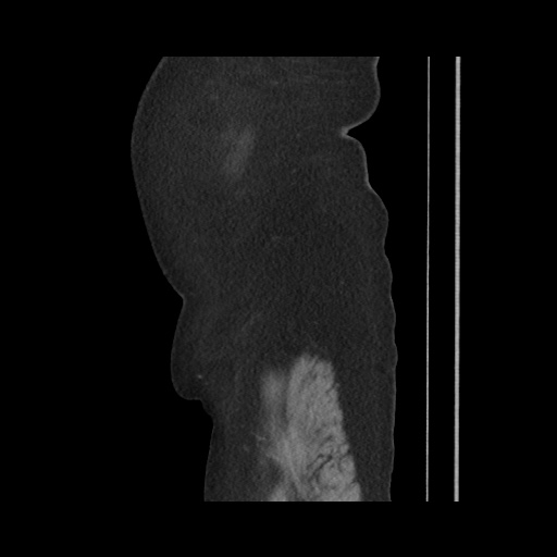 Acute cholecystitis with tensile fundus sign (Radiopaedia 71394-81723 Sagittal non-contrast 29).jpg