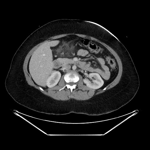 Acute diverticulitis - transverse colon (Radiopaedia 87063-103327 Axial C+ portal venous phase 66).jpg