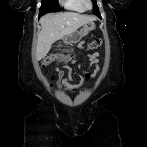 Acute diverticulitis - transverse colon (Radiopaedia 87063-103327 Coronal C+ portal venous phase 56).jpg