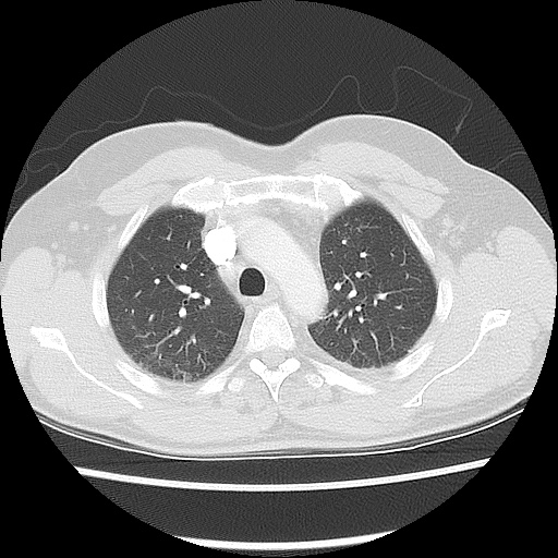 Acute epicardial fat necrosis (Radiopaedia 42327-45440 Axial lung window 20).jpg