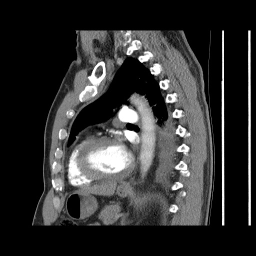 Acute epicardial fat necrosis (Radiopaedia 42327-45440 Sagittal C+ CTPA 45).jpg