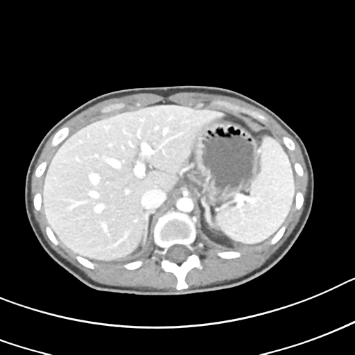 Acute gangrenous appendicitis with perforation (Radiopaedia 40152-42662 Axial C+ portal venous phase 14).png