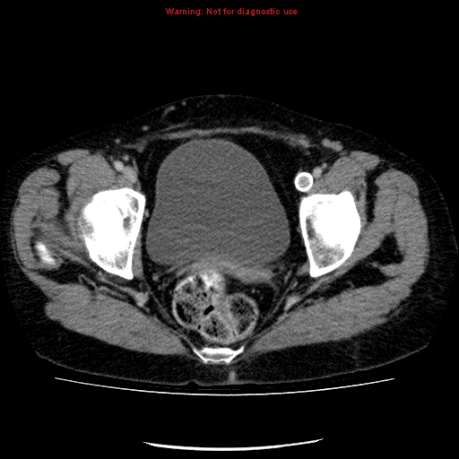 File:Acute gangrenous cholecystitis (Radiopaedia 10123-10661 Axial C+ portal venous phase 94).jpg