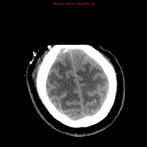 File:Acute hemorrhagic leukoencephalitis (Radiopaedia 14076-72275 Axial non-contrast 39).jpg