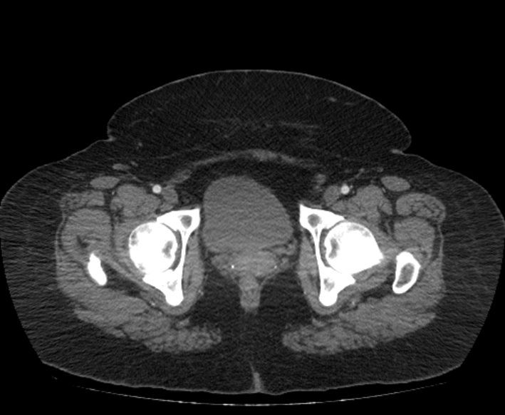 Acute mesenteric ischemia (Radiopaedia 80029-93316 Axial C+ arterial phase 130).jpg