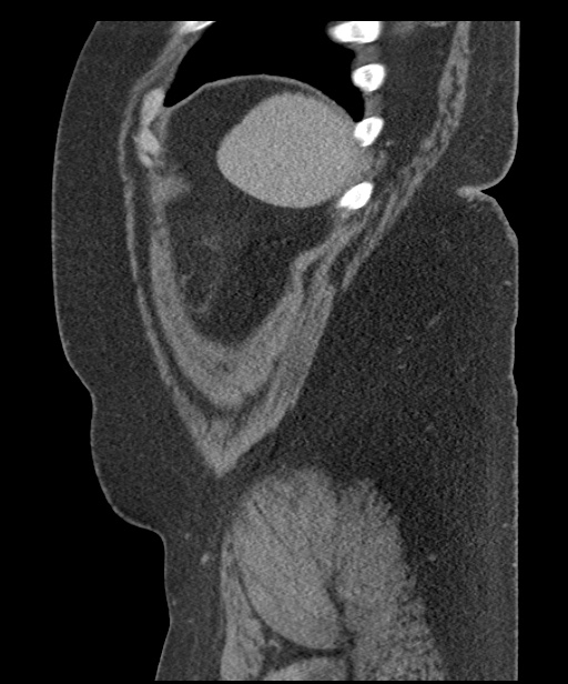 Acute mesenteric venous ischemia (Radiopaedia 46041-50383 Sagittal C+ portal venous phase 107).jpg