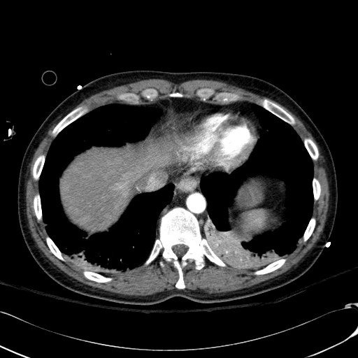Acute myocardial infarction in CT (Radiopaedia 39947-42415 Axial C+ arterial phase 114).jpg