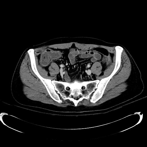 Acute myocardial infarction in CT (Radiopaedia 39947-42415 Axial C+ portal venous phase 99).jpg