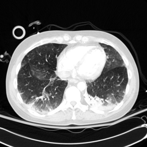 Acute myocardial infarction in CT (Radiopaedia 39947-42415 Axial lung window 97).jpg